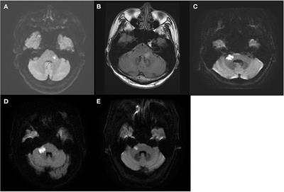 Positive horizontal-canal head impulse test is not a benign sign for acute vestibular syndrome with hearing loss